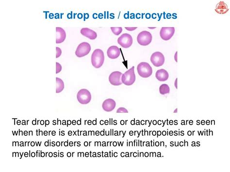 red drop tk test|What is the significance of teardrop cells (dacrocytes) .